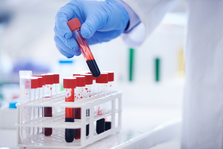 liquid biopsy sample